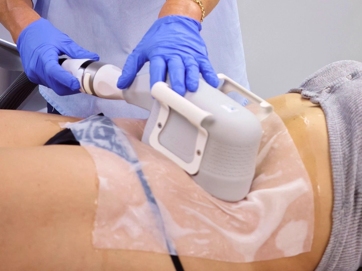 cryolipolyse a sainte croix