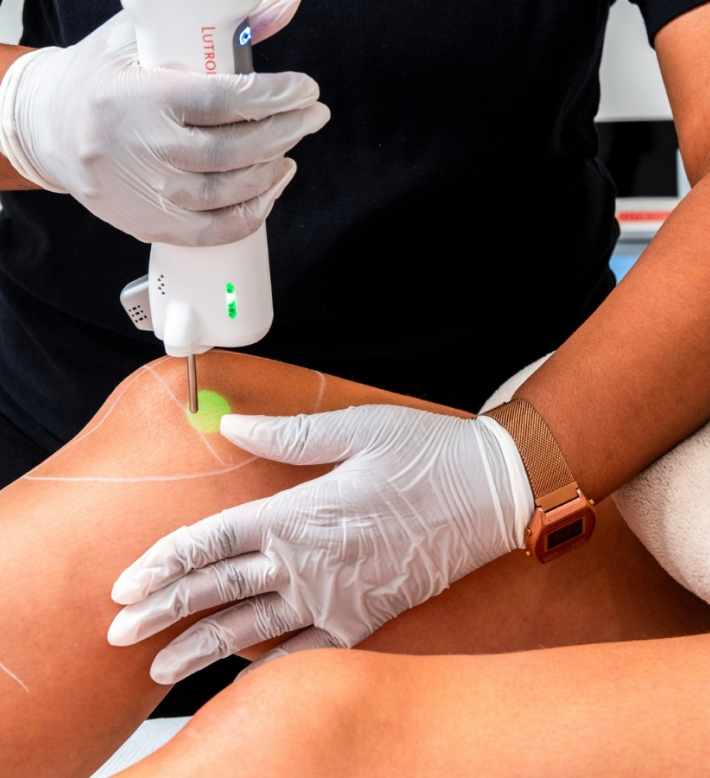 epilation laser sainte croix