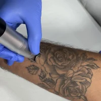 détatouage
